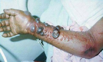 Ebola ubila više od 700 ljudi širom zapadne Afrike