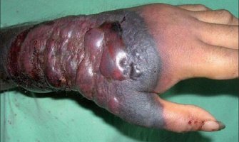 Međunarodna vanredna situacija zbog ebole