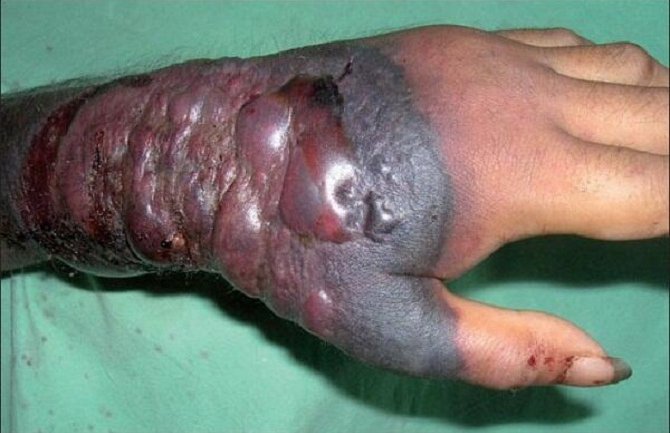 Međunarodna vanredna situacija zbog ebole