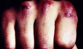 U tuči u Tuzima povrijeđeno više osoba