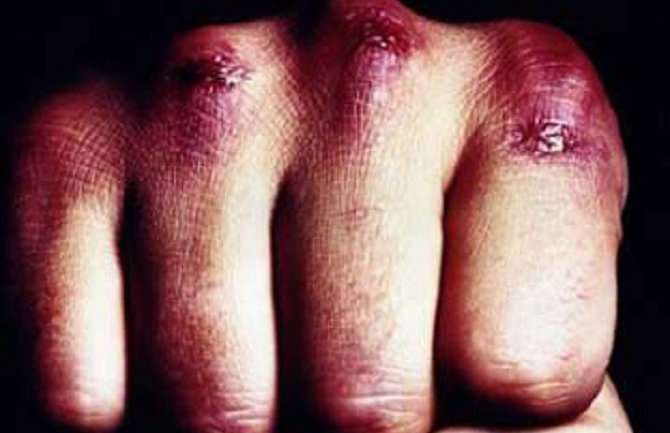 U tuči u Tuzima povrijeđeno više osoba