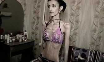 Zastrašujuće posljedice anoreksije