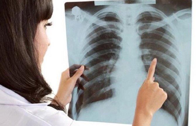 Vazduh izaziva karcinom pluća