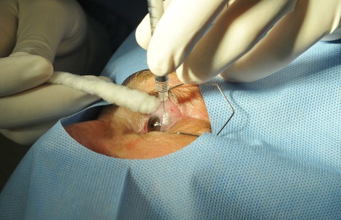 Na operaciju katarakte čeka više od hiljadu pacijenata