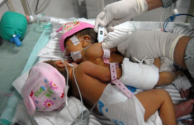 Dvije djevojčice dijele jedno srce