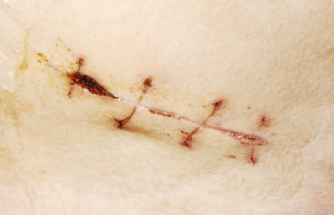 Ruski hirurg sam sebi izvadio slijepo crijevo