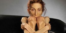 Anoreksičnu glumicu nijedna bolnica neće da primi, jer ima 18 kg (VIDEO)(FOTO)