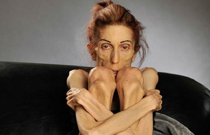 Anoreksičnu glumicu nijedna bolnica neće da primi, jer ima 18 kg (VIDEO)(FOTO)