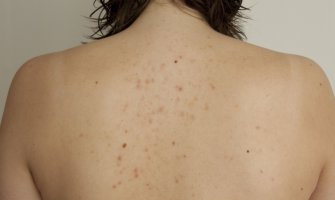 Izbacite ove namirnice i preparate ako želite da pobijedite bubuljice na leđima