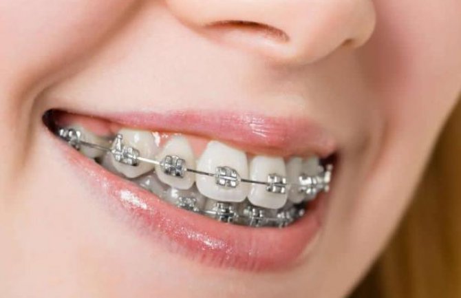 Evo šta fiksna proteza radi sa vašim zubima (VIDEO)