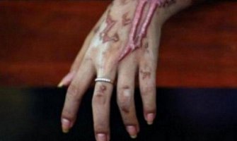 Ruska turistkinja polivena kiselinom u Indiji