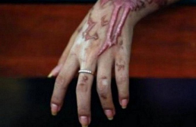 Ruska turistkinja polivena kiselinom u Indiji