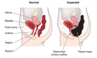 Riješite se naduvanog stomaka zauvijek i izravnajte ga uz ova 3 savjeta