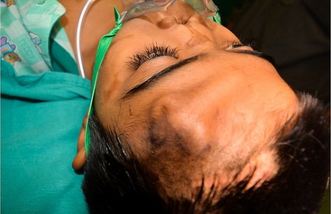 Dječak(12) dobio nos na čelu!