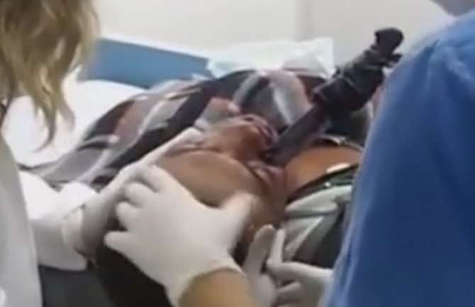 Pijani čovjek sa zarivenim nožem u lice došao na kliniku, ljekari ga spasili (Video)