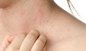 Od šuge bolovalo 385 osoba: Najviše u Podgorici i Bijelom Polju