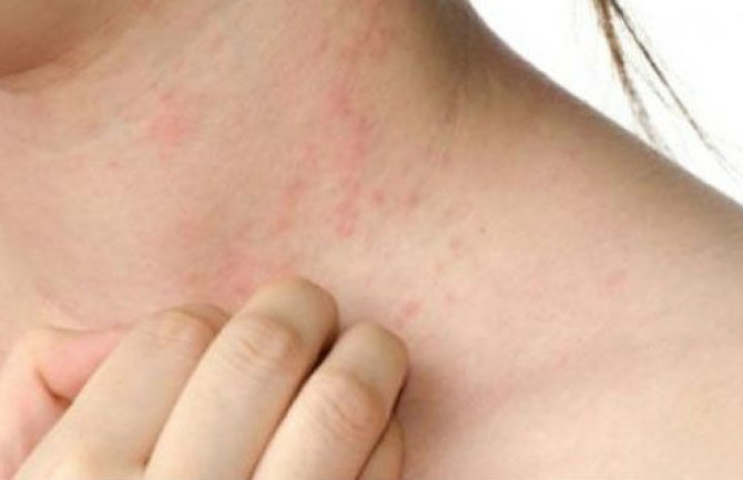 Od šuge bolovalo 385 osoba: Najviše u Podgorici i Bijelom Polju