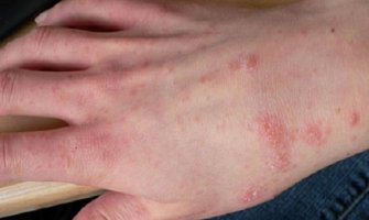 Od 424 oboljele osobe, svaka četvrta imala šugu