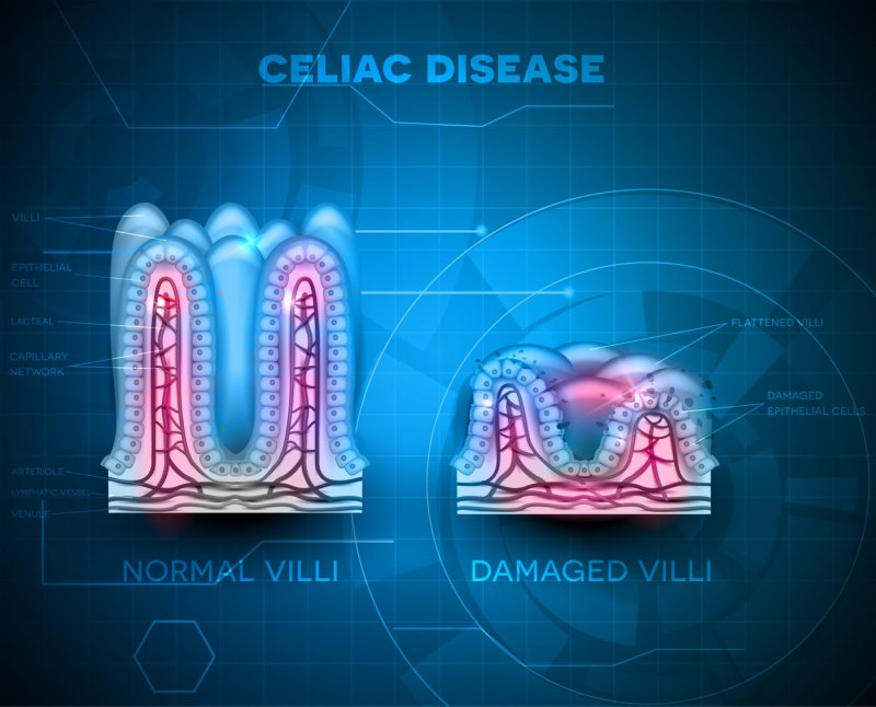 bigstockCeliacDisease121682129