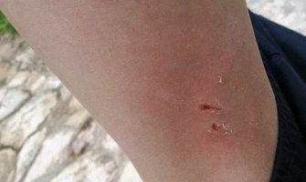 Nikšić: Pas lutalica napao i ugrizao dječaka 