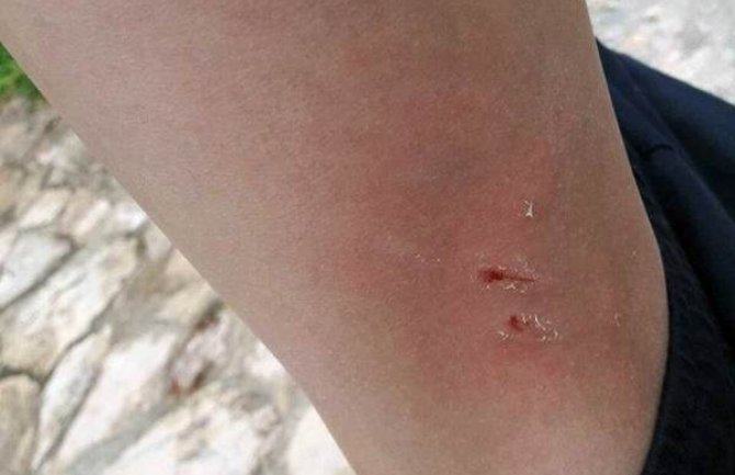 Nikšić: Pas lutalica napao i ugrizao dječaka 