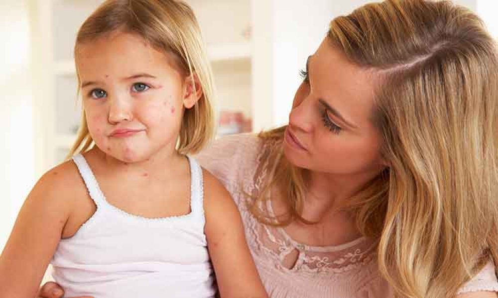 chickenpoxgirlmother