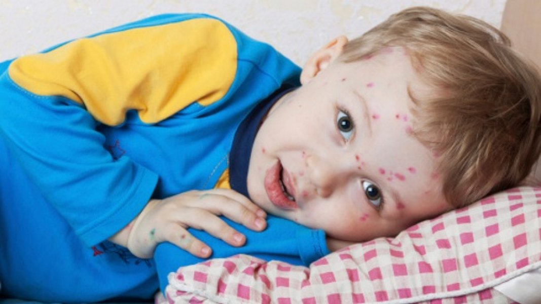 Maleboginjesimptomiilecenje