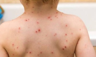 Oboljeli od malih boginja na kućnom liječenju