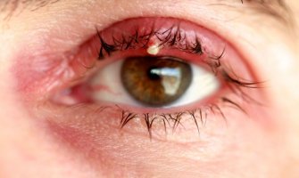Kad vam se pojavi čmičak na oku, nemojte ga dirati