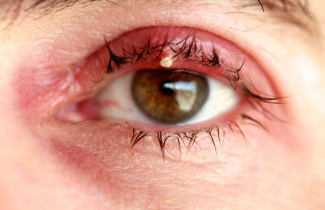 Kad vam se pojavi čmičak na oku, nemojte ga dirati