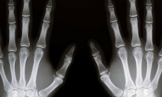 Izuzetno rijetko oboljenje: Nestale kosti pacijentkinje (FOTO)