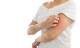 Registrovano 424 oboljelih od šuge, najviše u Bijelom Polju 