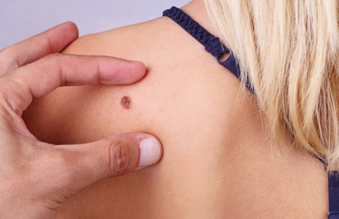 Od karcinoma kože godišnje oboli 300 građana