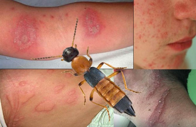 Virpazar: Više osoba zatražilo pomoć zbog opekotina  zadobijenih od bube pederus