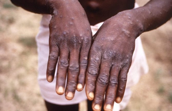 SZO vjeruje da se epidemije majmunskih boginja u Africi mogu zaustaviti u narednih šest mjeseci